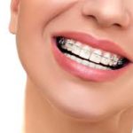 Aparelho ortodontico|Dra. Marcelle Chedid| Dentista Rj