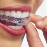 Aparelho Invisalign