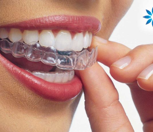 Aparelho Invisalign